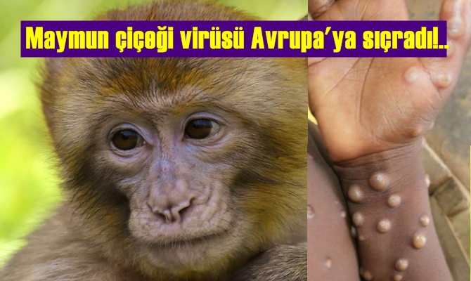 Yeni Virüs! Maymun çiçeği virüsü Avrupa'ya sıçradı!..